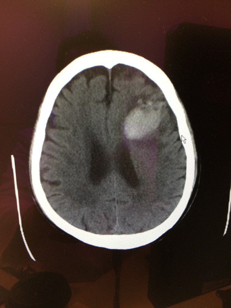 老翁後來馬上轉急診做電腦斷層後，發現左側前額葉出現「急性腦出血」。圖／院方提供