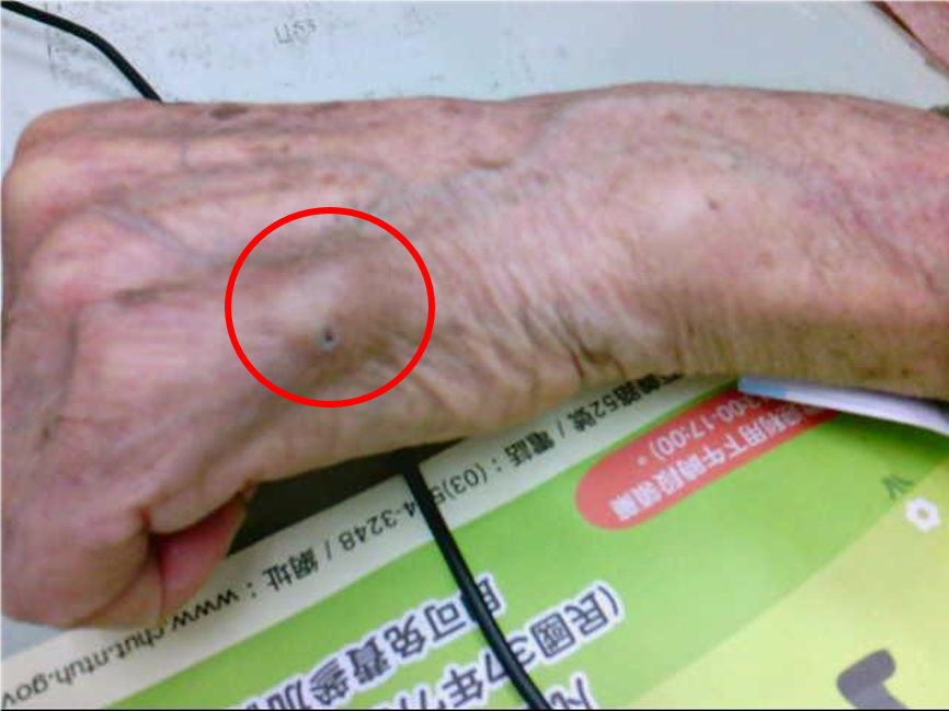 紅圈處為左手第五指表皮樣囊腫，治療以切除為主。圖／台大新竹分院提供