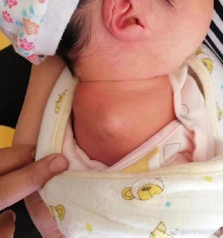 女嬰米米在四川省德陽腫瘤醫院出生，身體卻有殘疾，沒有右臂、左手手指粘連在一起，左腳一根腳趾呈畸形。圖取自微博