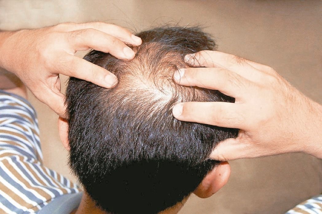 台大研究發現，強藍光能誘發毛囊幹細胞活化，但目前仍不建議使用在人體生髮應用。圖／本報資料照片