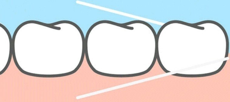 整排牙齒最後方的大臼齒，很多人在用牙線清牙時常忽略。圖／取自網路