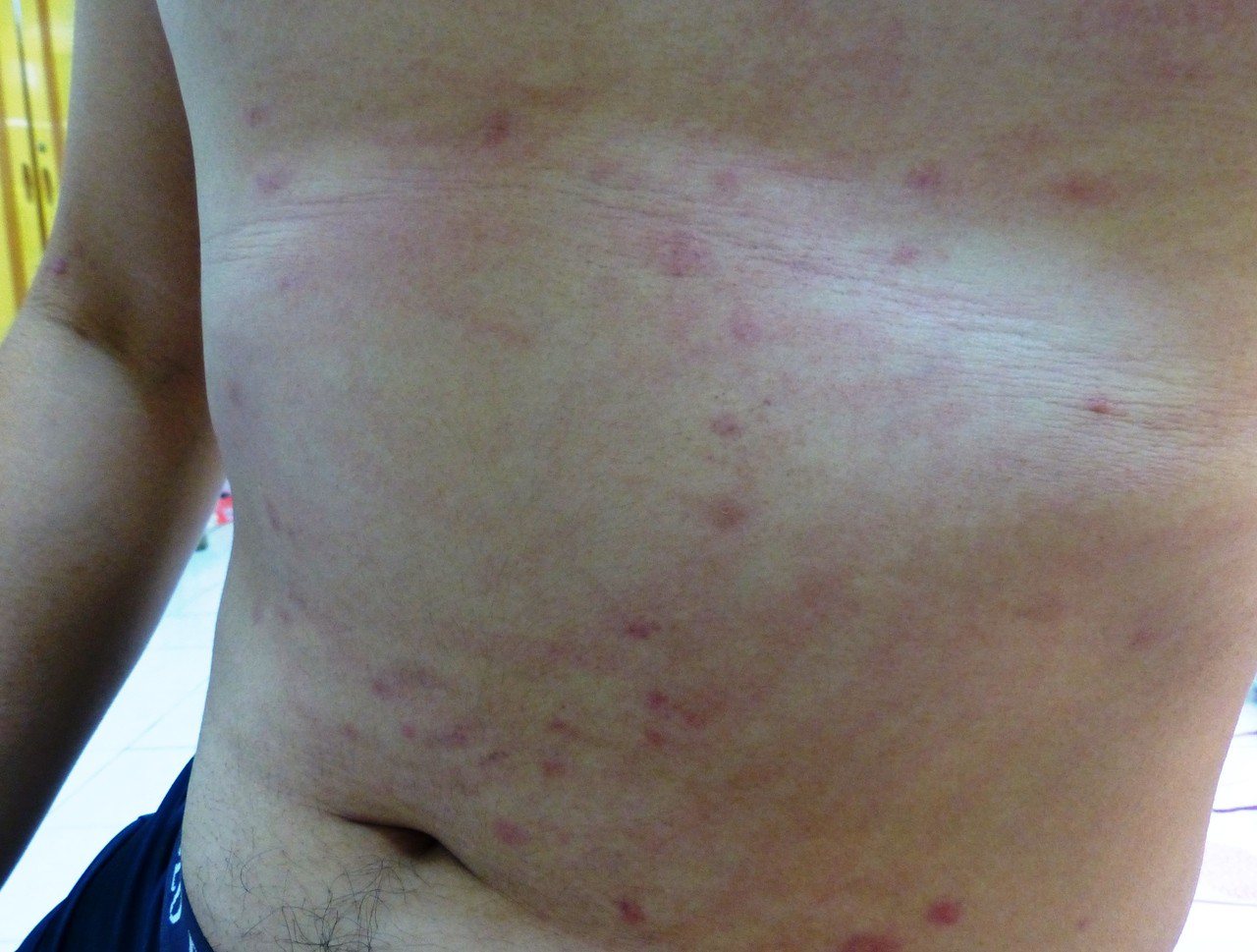季節交替，許多人發生皮膚過敏現象，長了疹子或全身搔癢。圖／聯合報系資料照片