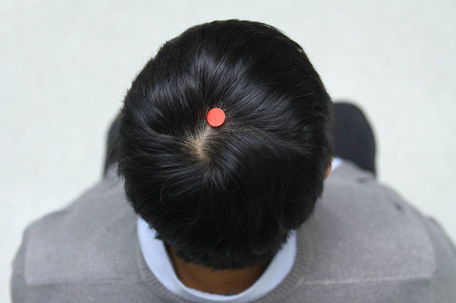 中醫師建議按摩頭頂百會穴有助安眠（紅點處）。 圖 ／報系資料照