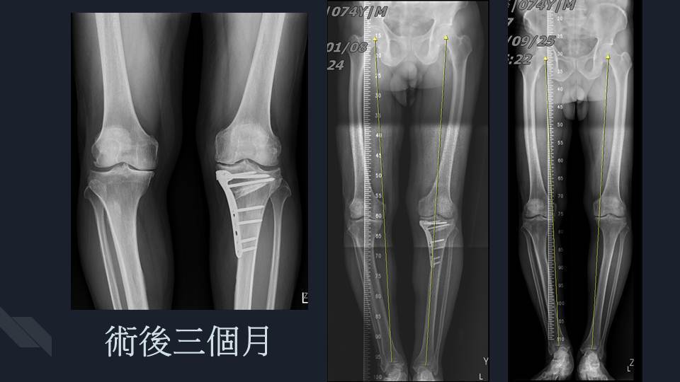 右膝內翻性退化性關節炎患者接受精準高位脛骨矯正保膝手術後的術後x光照片。圖／安南醫院提供