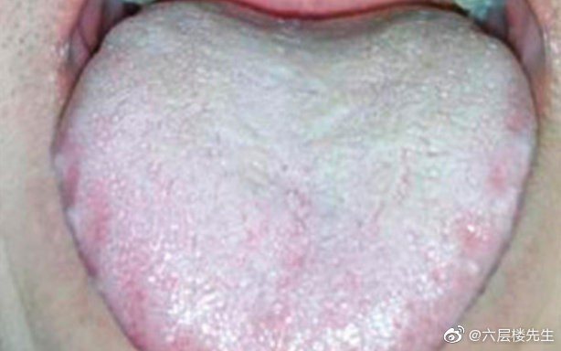 舌苔白又厚代表身體濕氣重？醫師解析真正成因
