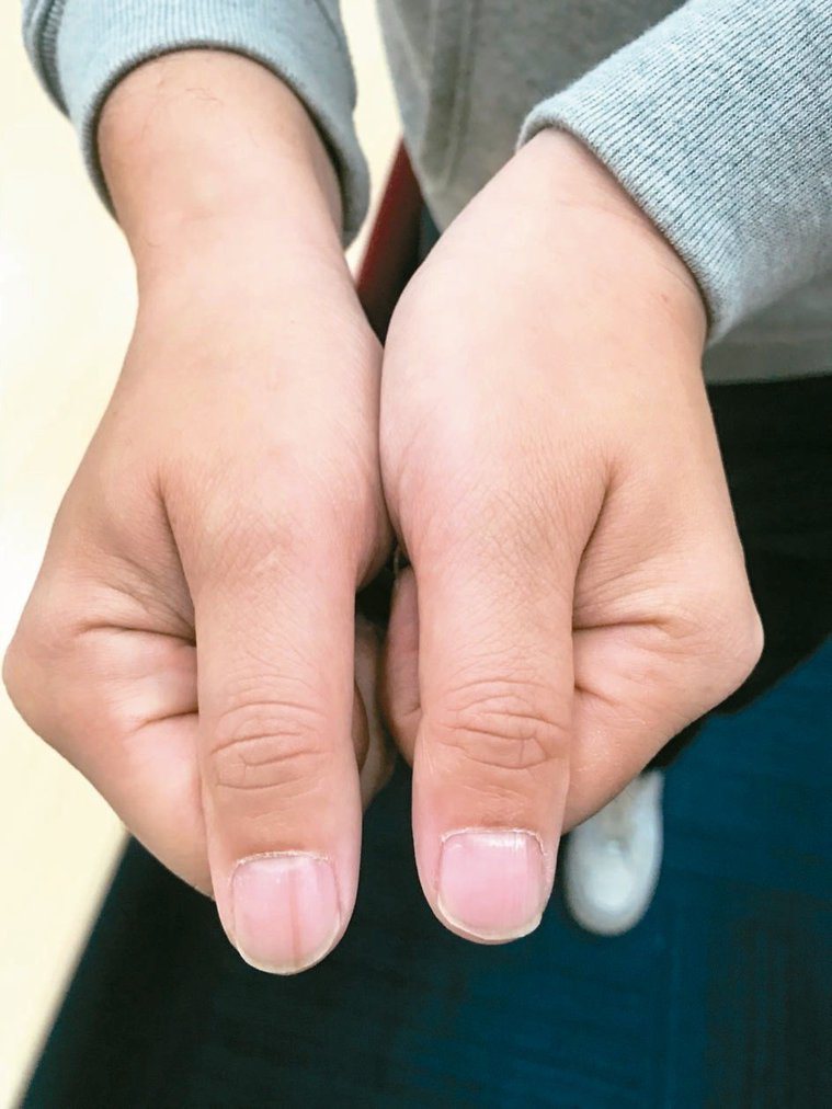 右手大拇指指甲出現淡淡黑色直線，是為「縱向黑甲症」。 圖／聯合報系資料照
