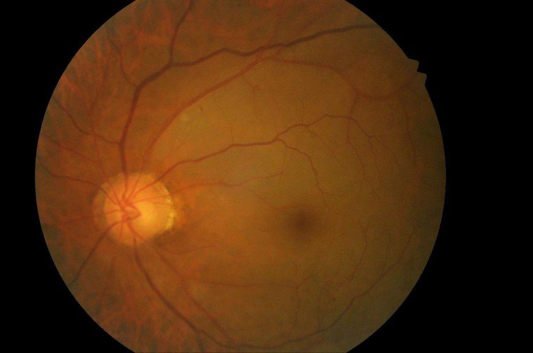 安南醫院一名患者左眼動脈阻塞型眼底中風，眼球明顯因為黃斑部區缺血以致變白無血色。...
