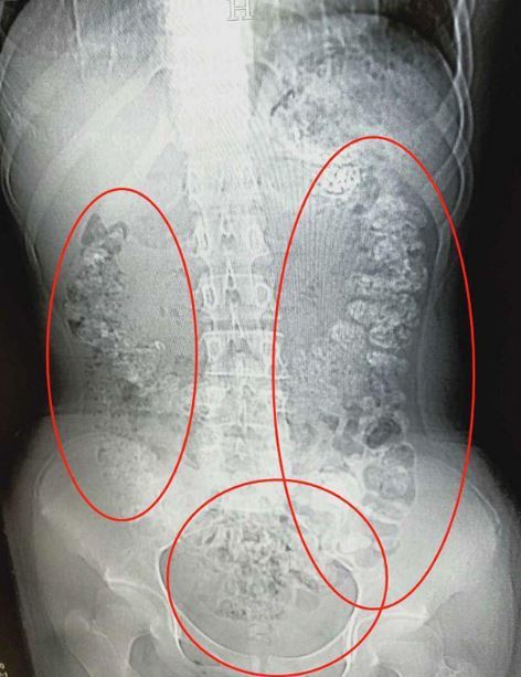 X光照曝女孩的胃有百餘顆未消化的奶茶珍珠。圖／翻攝自澎湃新聞