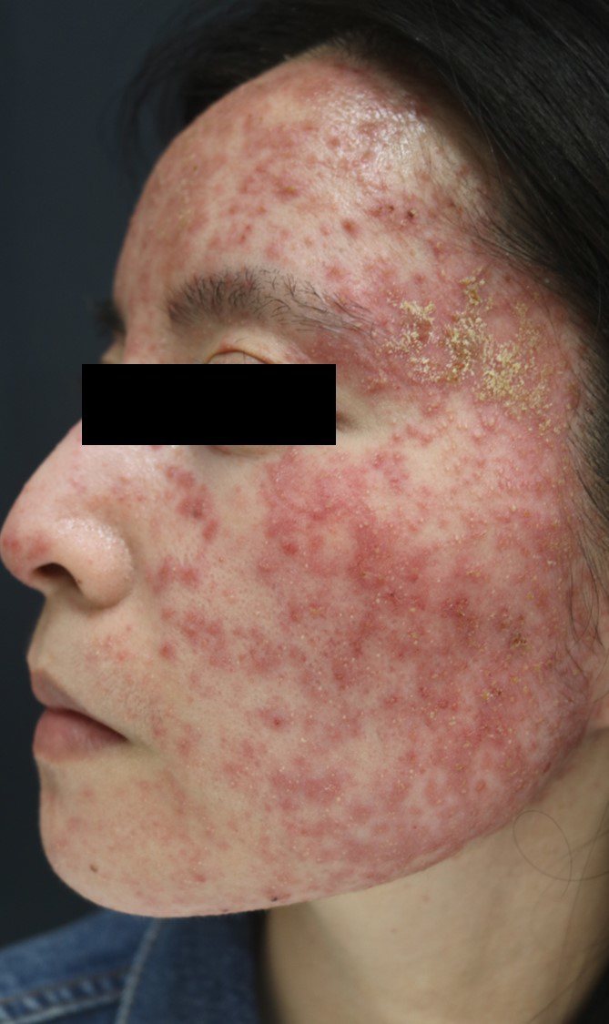 31歲的女性患者塗抹外用類固醇後，酒糟丘疹大爆發，臉部紅通通。圖／黃輝鵬醫師提供