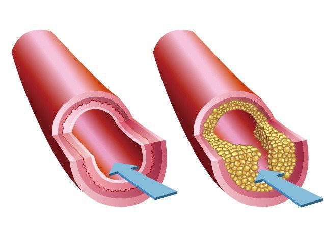 健康的血管血流通暢（左圖）。當脂肪形成堆積物或斑塊（右圖），開始堆積在血管中，就...
