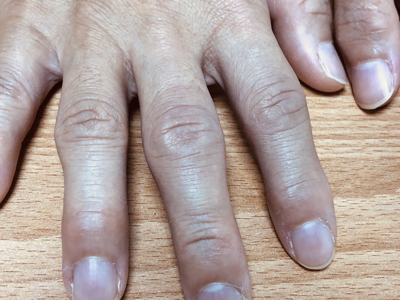 電腦族長期打電腦，過度使用手指使得關節變形、老化，退化性關節炎上身。圖／醫師洪維提供