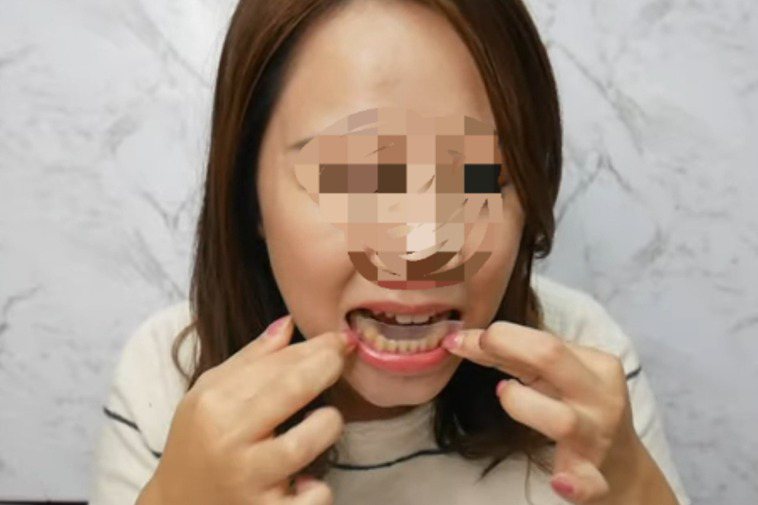 網路上可以找到許多分享牙齒美白貼片的po文。記者修瑞瑩／翻攝