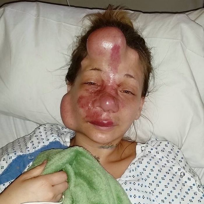 美國一名少女罹患了腦動脈血管畸形，臉上就有大面積粉紅色斑紋，有時候臉部還會出現像氣球一樣的突起物。