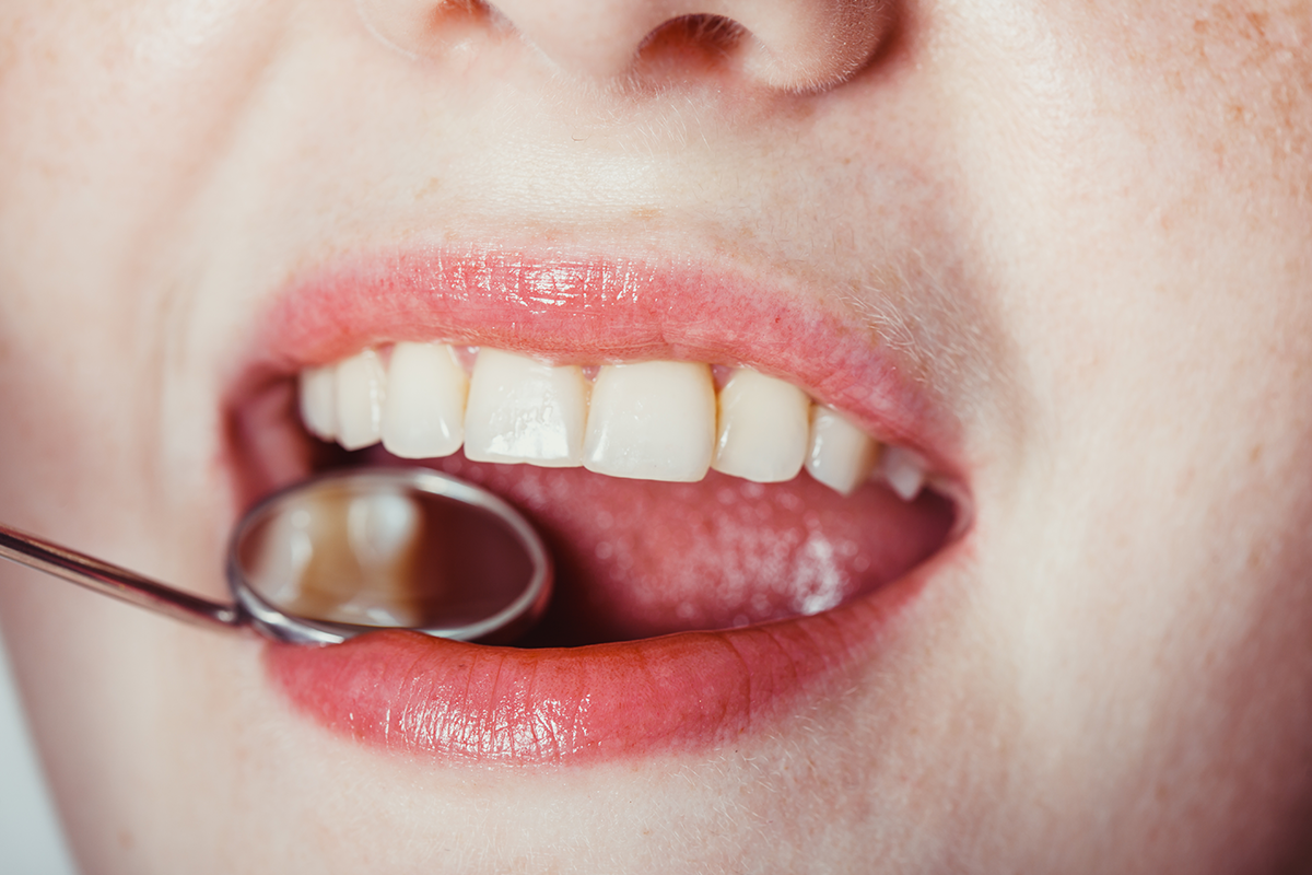 看診時患者經常詢問這個問題，為什麼有人補完牙仍然又蛀牙，甚至惡化成牙髓炎需要根管治療呢？