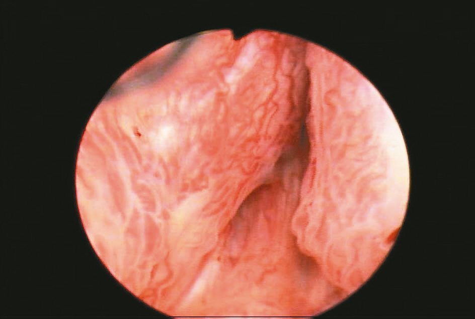 雷射攝護腺剜除術
圖1以內視鏡由尿道進行手術，可見腫脹攝護腺完全阻塞膀胱出口，上面有許多易出血的血管。