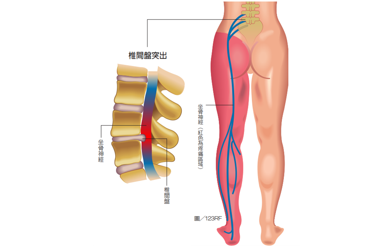 坐骨神經痛<br>
坐骨神經由第四、第五腰椎及前三條薦椎匯集而成，常見疼痛原因為椎間盤突出、脊椎滑脫、骨刺造成。<br>
疼痛範圍通常由臀部沿大腿後側向下蔓到小腿，甚至痛到足背或腳底。<br>