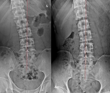 吳姓男子接受聲波動力平衡系統治療，腰椎側彎角度從15度（左），回復到12度（右），矯正側彎角度為3度。圖／活力得中山脊椎外科醫院