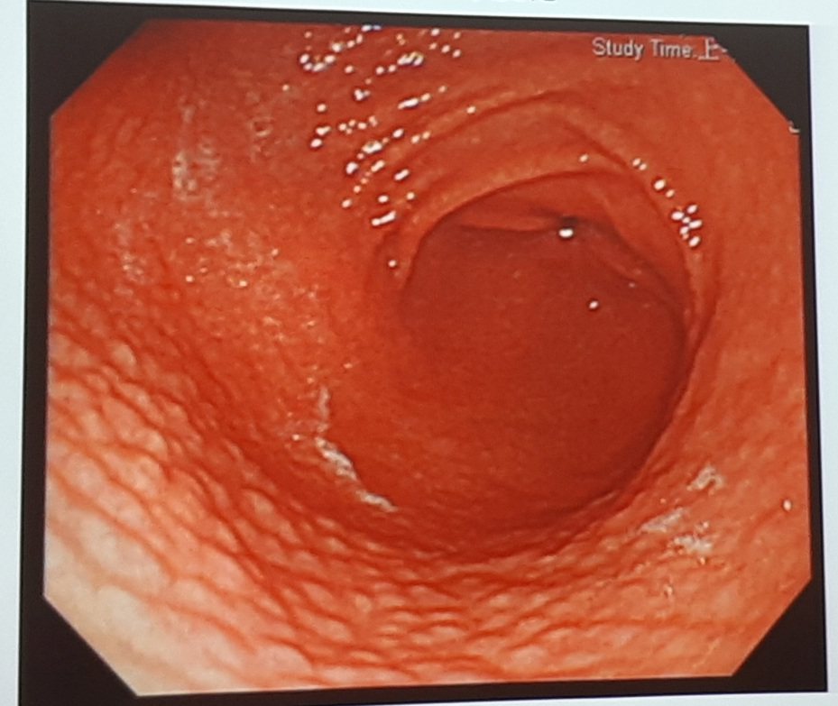 個案胃鏡影像發現胃幽門附近有廣泛發炎，表面形成類似雞皮疙瘩的結節變化。圖／書田診所提供