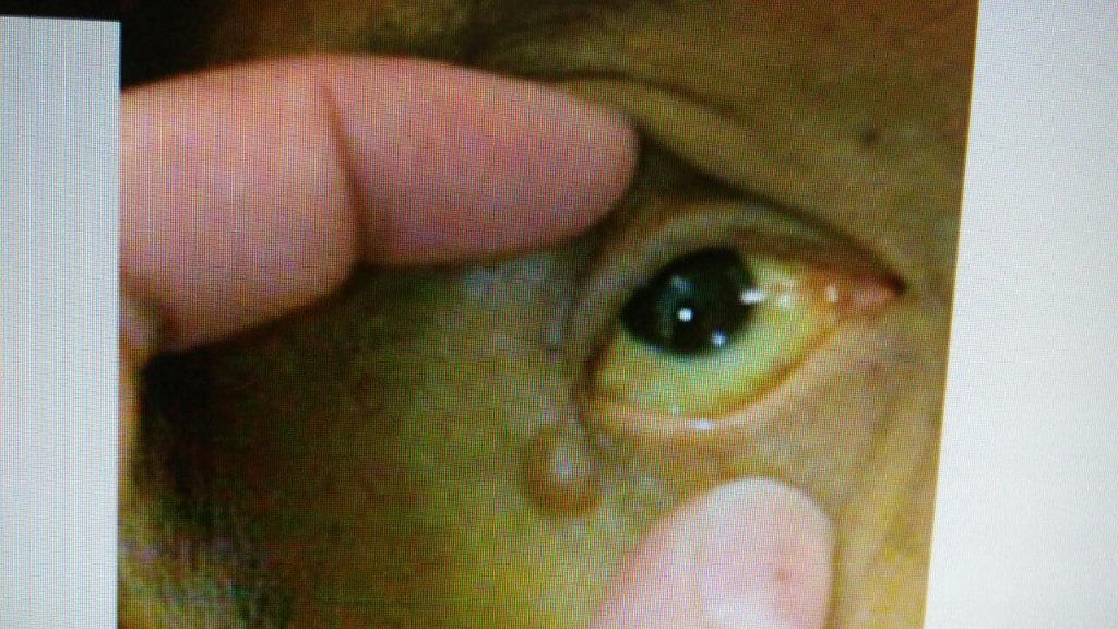 患者眼睛出現黃疸症狀，圖非當事人。圖／台中慈濟醫院提供