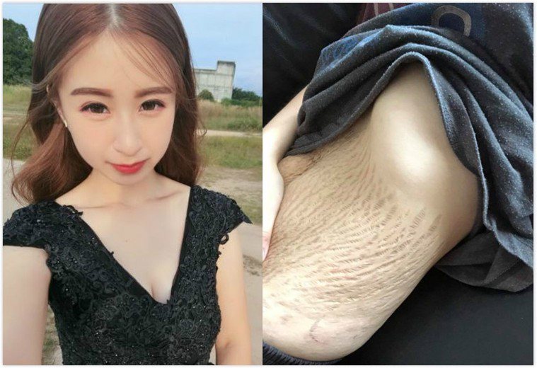 馬來西亞婦人朵琳5年前生下四胞胎，卻因生產後肚皮嚴重鬆弛，腹部的腹直肌分離，導致...