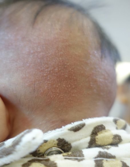 一名嬰兒出生後因睡姿造成頭型歪斜，媽媽為他配戴頭盔以矯正頭型，卻因悶熱導致後頭部長熱疹。圖／茂盛醫院提供