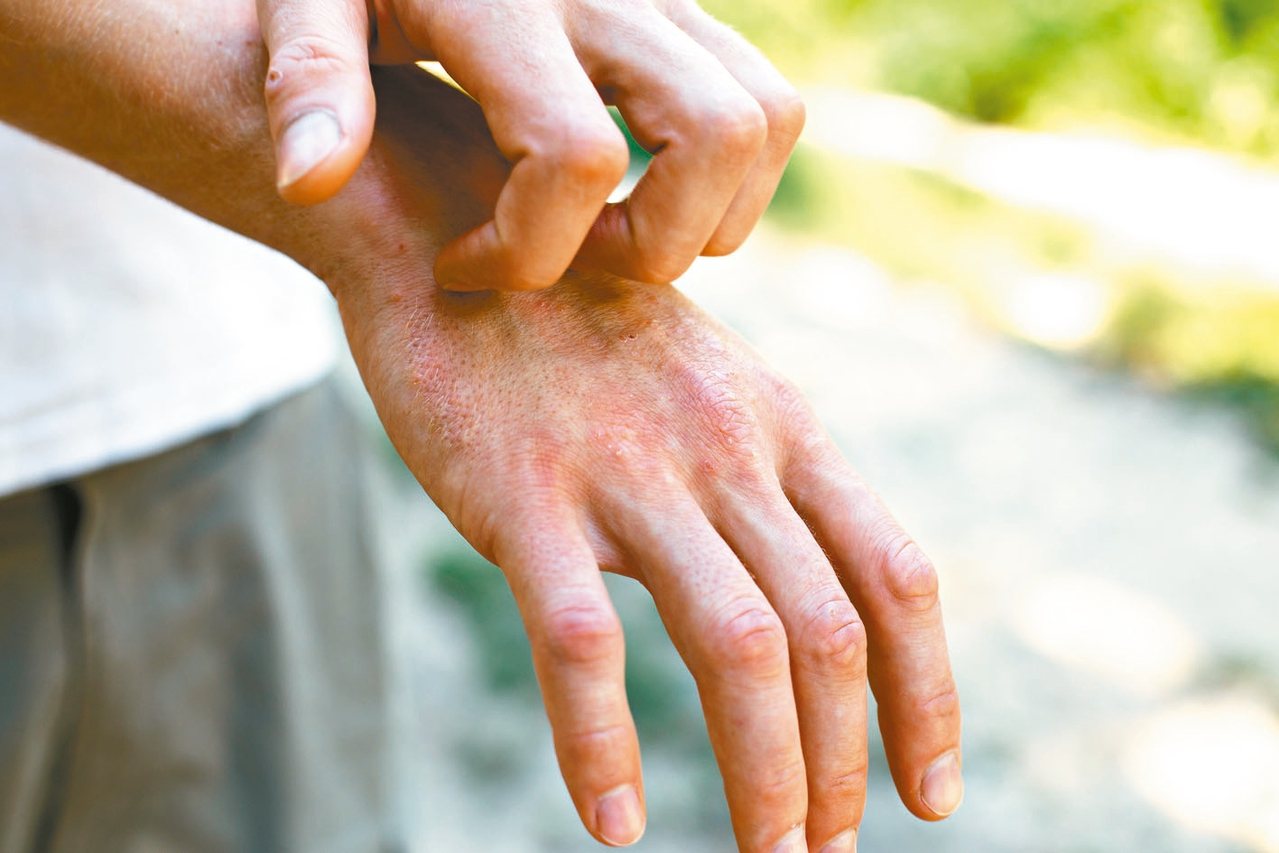 乾癬又稱牛皮癬，是一種慢性反覆發作的皮膚病。