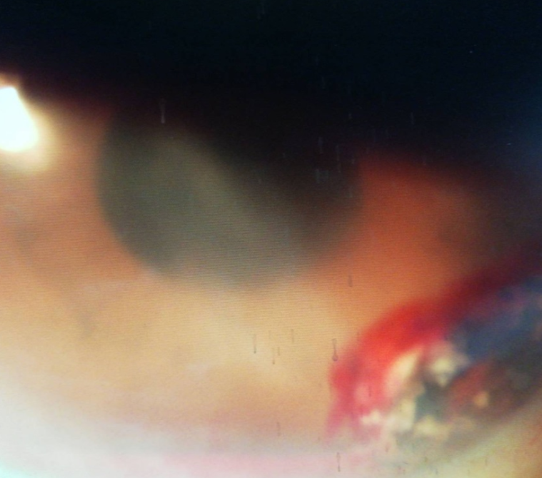 從裂隙燈下觀察，可見患者左眼下眼角的大血塊，還有閃亮的鐵結晶。圖／洪啟庭醫師提供