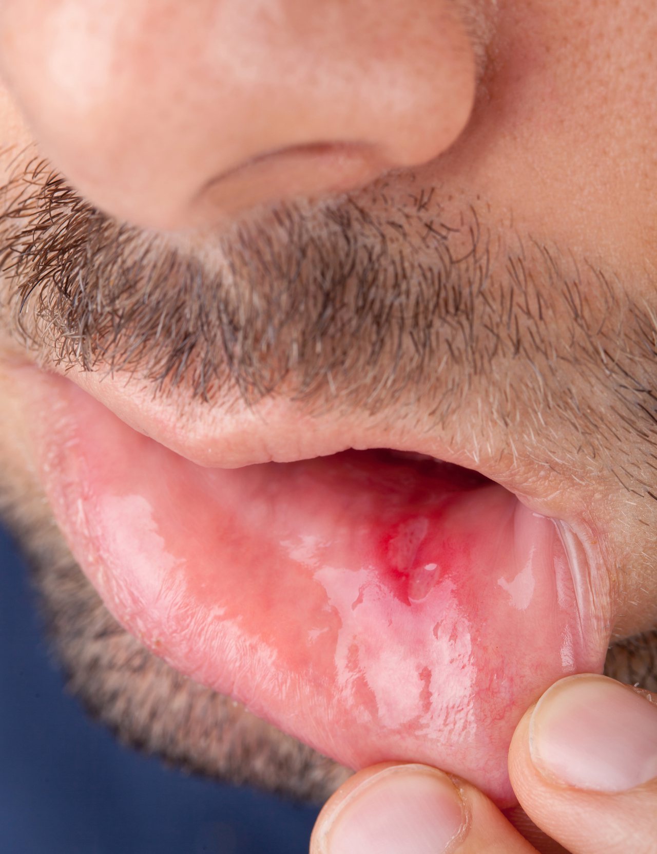 嘴破最常見的原因是缺乏維他命B？