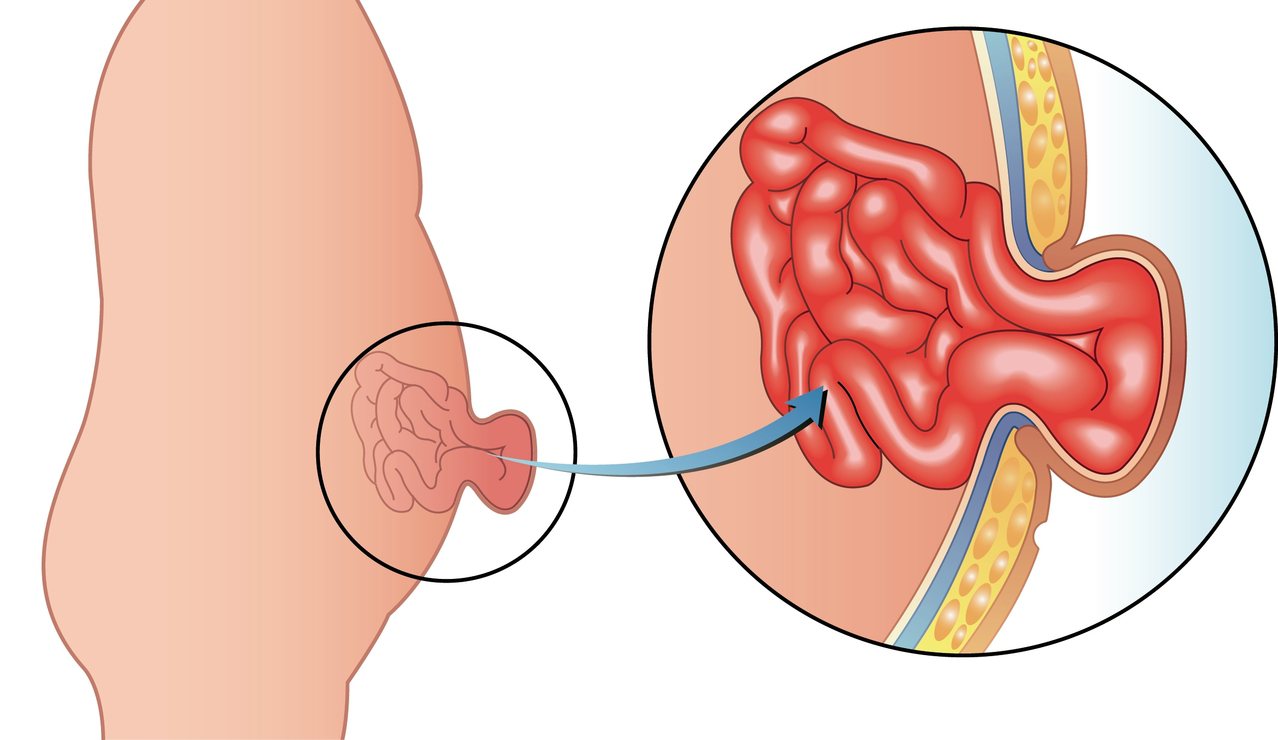 俗稱「墜腸」的疝氣，是部分內臟，經腹壁肌肉或筋膜破洞或缺損，向外不正常凸出的現象，幼兒和成人都會發生。