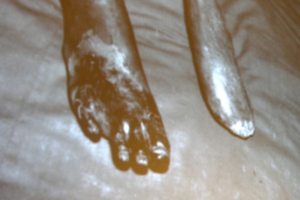 台灣烏腳病醫療紀念館播放烏腳病患的老照片，清楚呈現壞死的腳趾和截去腳趾的腳掌，令人心酸。