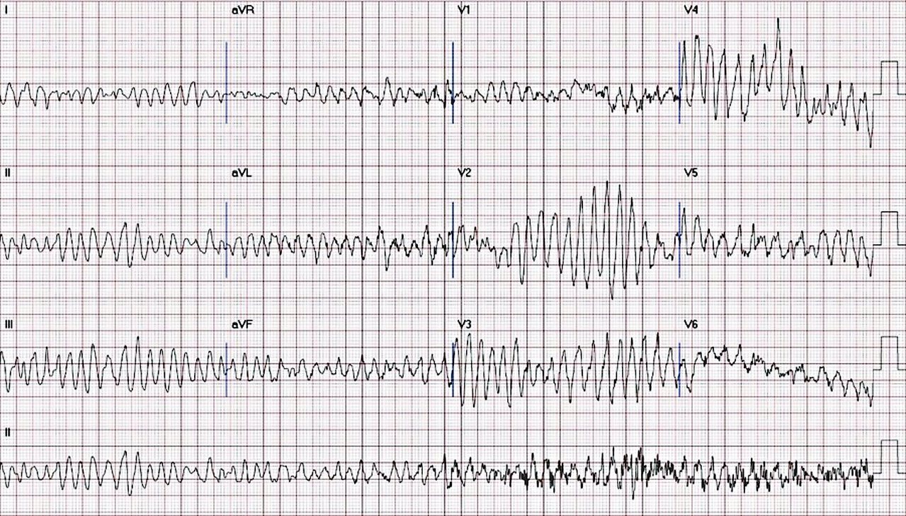 心電圖顯示，患者暈倒後心室顫動。