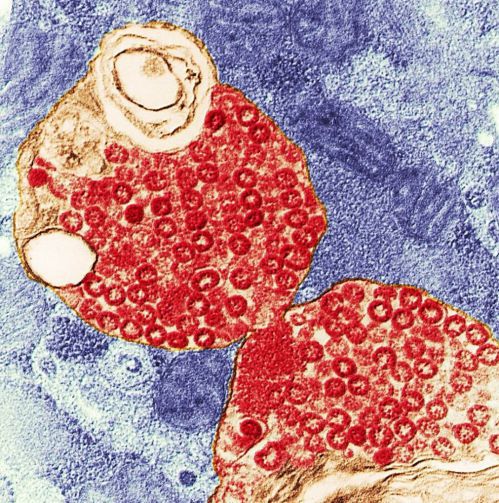 顯微鏡下SARS病毒侵犯細胞圖。圖／聯合報系資料照片