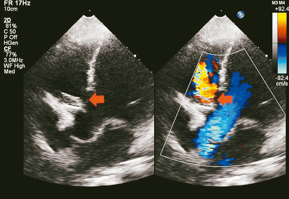 心臟超音波檢查，箭頭處顯示第二型的心房中隔缺損。