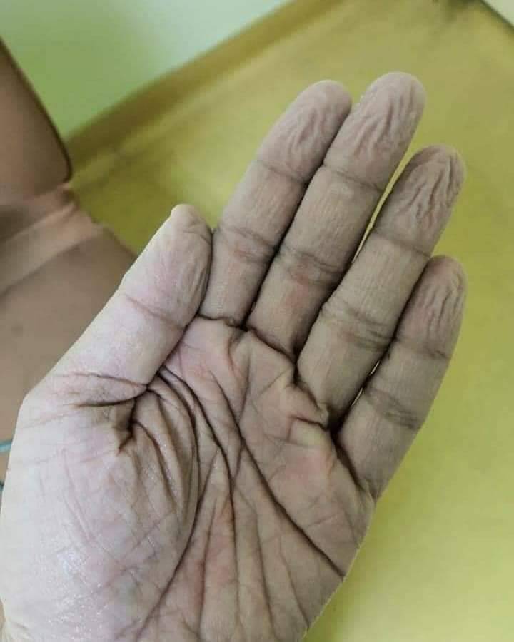 醫護人員脫下手套後雙手發白皺痕的照片，網友稱讚：「這是天使的皺痕」。圖／翻攝自台東大小事（109年）