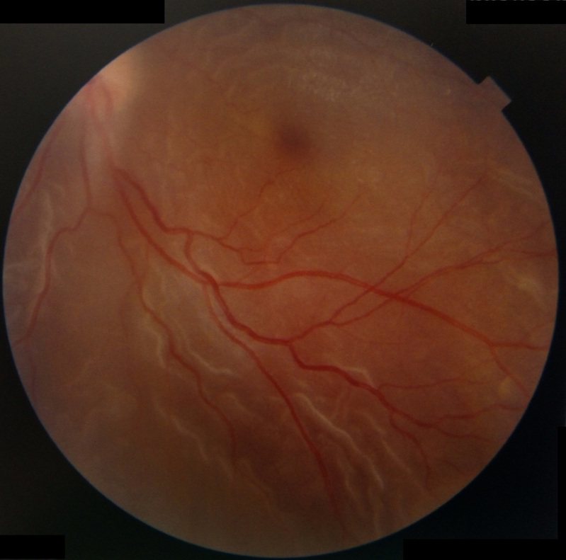 國小6年級男童因左眼遭水球擊中受創，視網膜嚴重剝離四分之三，視力僅剩不到0.1。圖／德恩診所提供