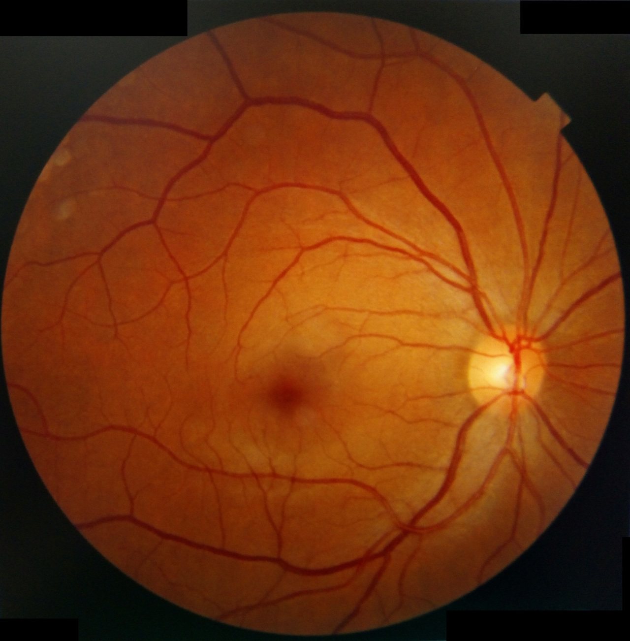 正常的眼球視網膜，與剝離的眼球迥然不同。圖／凱恩診所提供