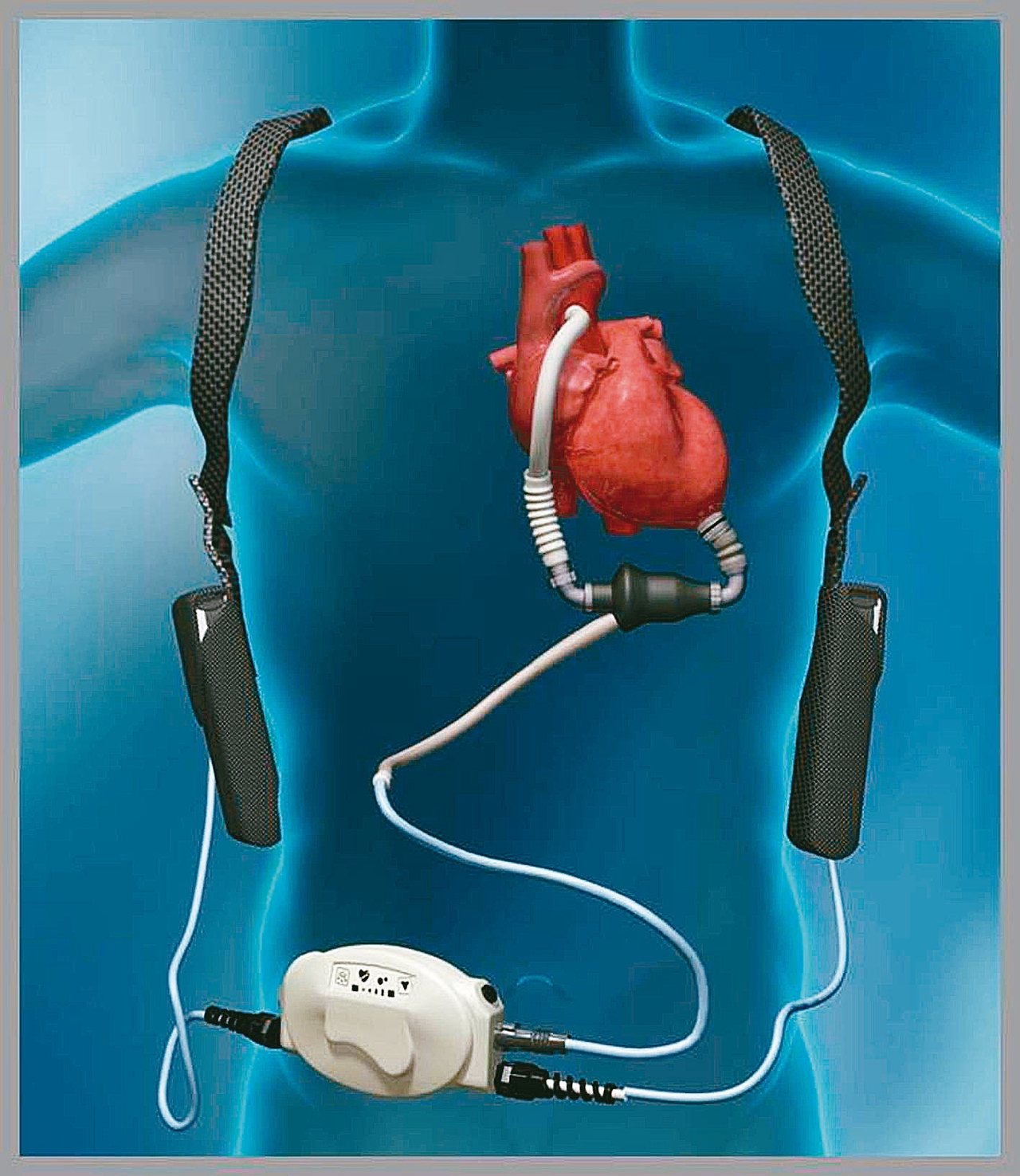 心室輔助器（圖）具有幫浦功能，可幫助心臟運作，左為心室輔助器連接示意圖。