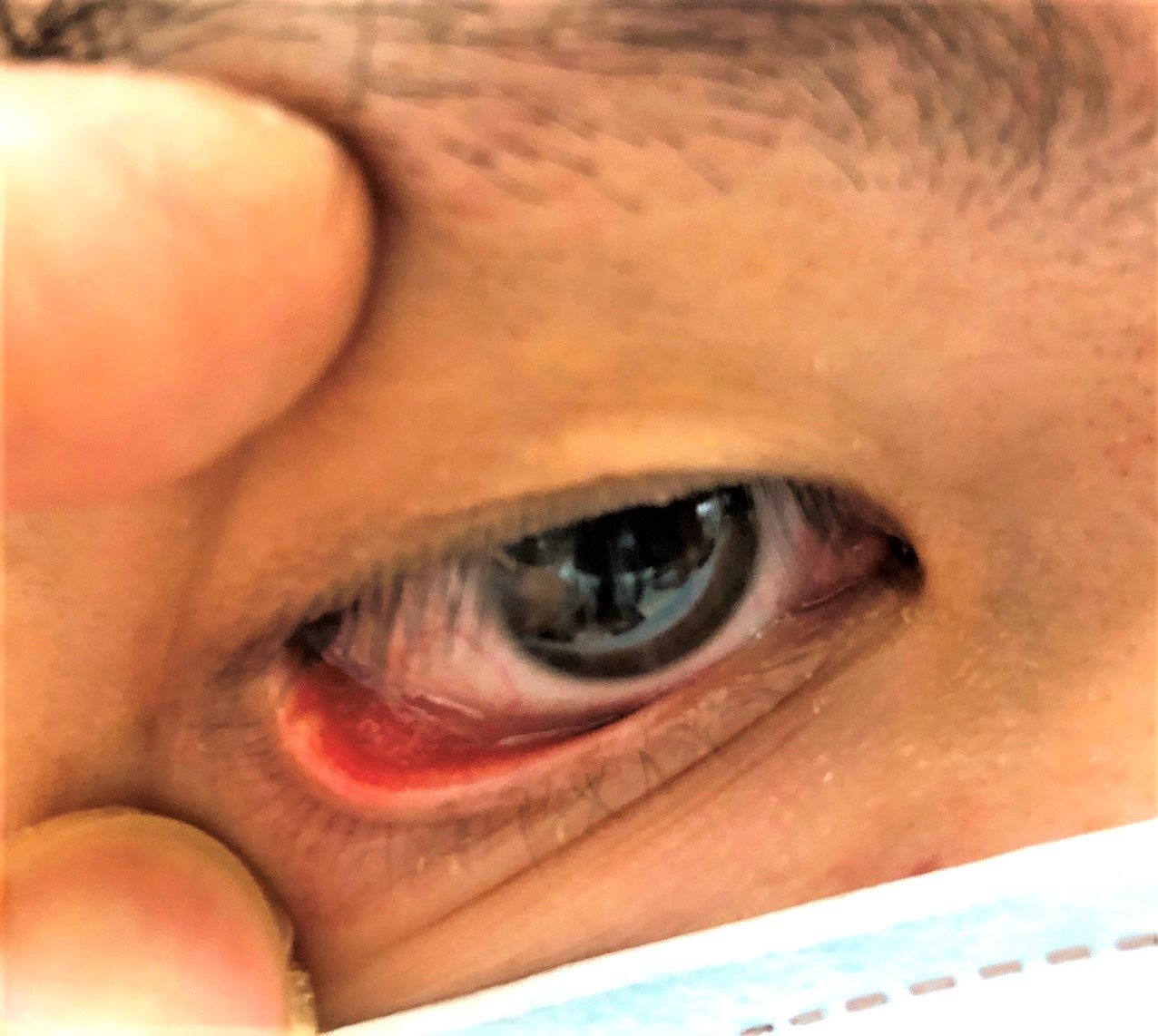 針眼是常見的眼皮腺體炎症，發作起來有時惱人，許多人卻不知如何才能有效消腫。圖／書田診所提供