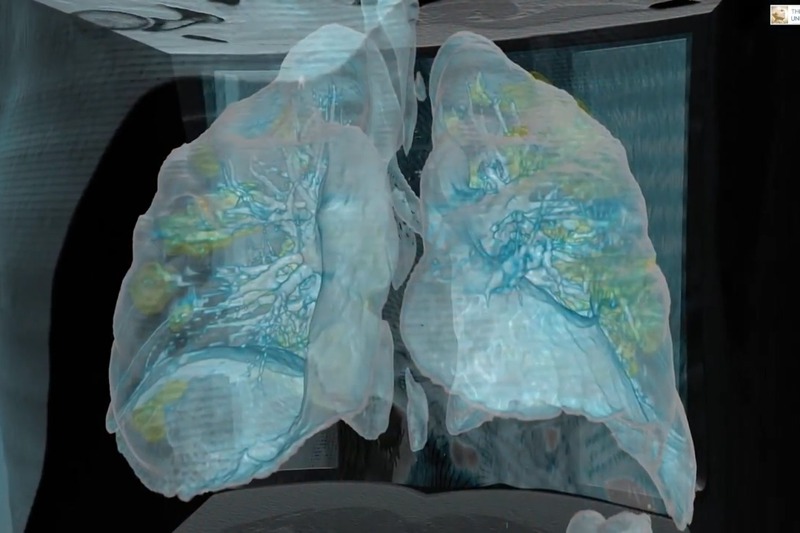 美國喬治華盛頓大學醫院日前公布新冠肺炎患者肺部受損狀況的3D影像，綠色部位為因感染受損的肺部組織。公布影像的莫特曼醫師表示，希望藉此讓人們了解新冠病毒的嚴重性。圖／翻攝自YouTube Surgical Theater