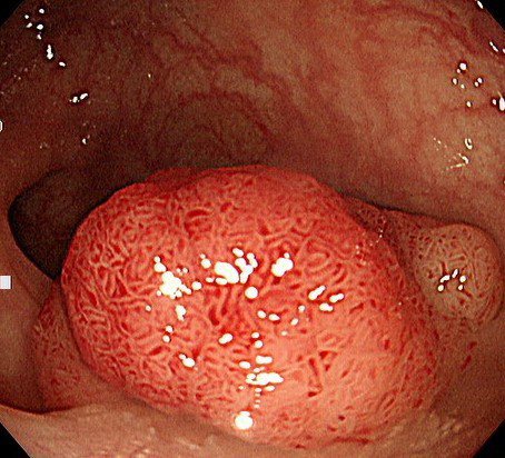 早期大腸癌 靠大腸鏡免開刀