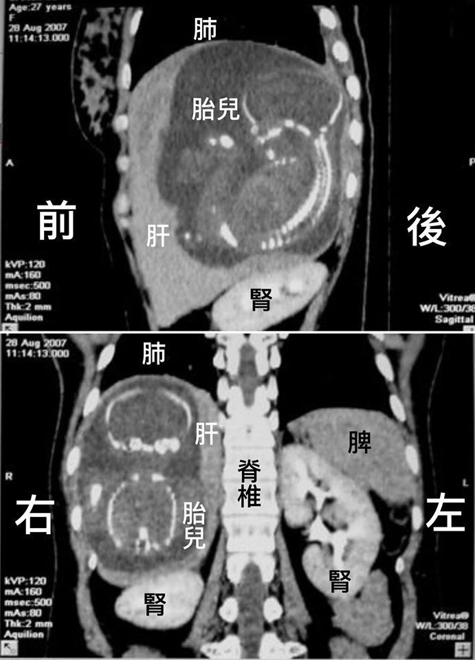 越南醫師在2007年時貼文陳述一名女子肝臟子宮外孕，胚胎並成長到23周，從影像中可以清楚看到肝臟內的胎兒。圖／取自陳志金臉書