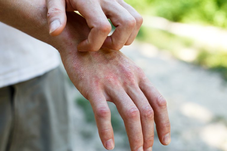 異位性皮膚炎患者臉上先出現紅腫、劇癢，再逐漸分布在手腕及腳後彎處，會反覆發作。圖...
