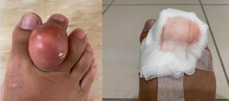 網友的腳趾腫到宛如一顆雞蛋大。圖擷自facebook