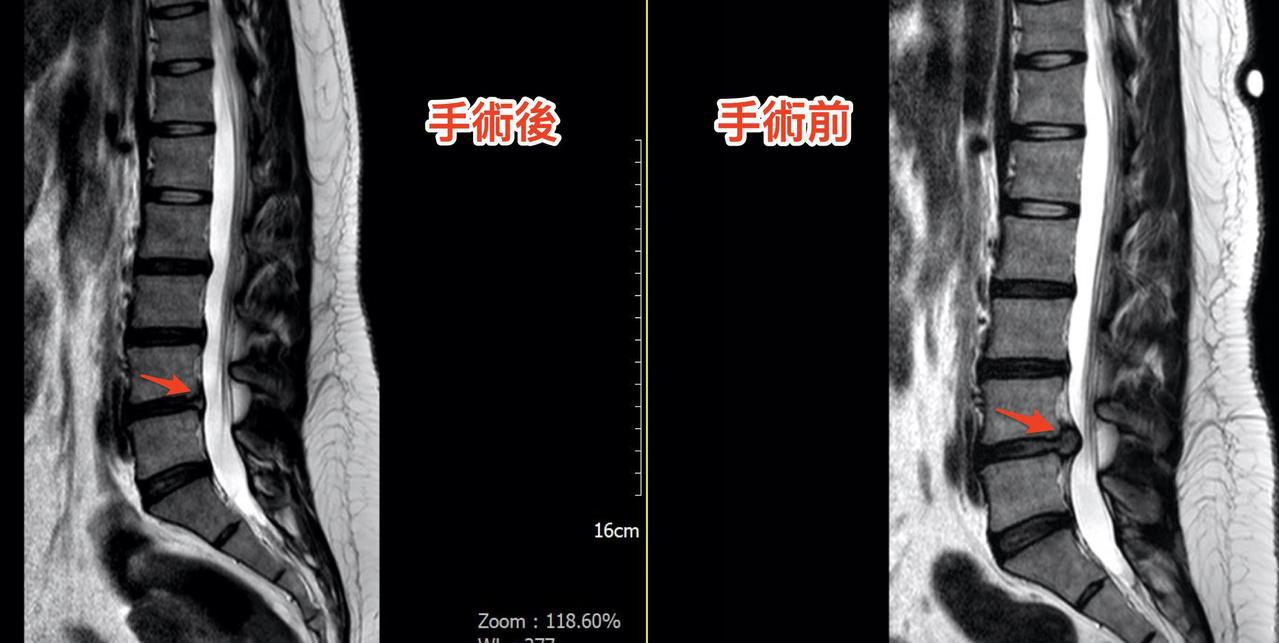 核磁共振(側面)可看出原本突出的椎間盤(右方紅色箭頭黑黑的凸出物)， 手術後幾乎全部移除(左方紅色箭頭)， 原本被壓扁的神經也膨脹回到原本的大小。圖／部立苗栗醫院提供