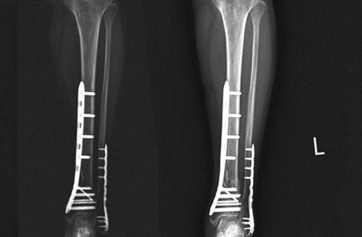 婦人補充對的營養後，骨頭由暗黑（左）轉為白色（右）顯示恢復癒合能力。 圖／澄清醫...