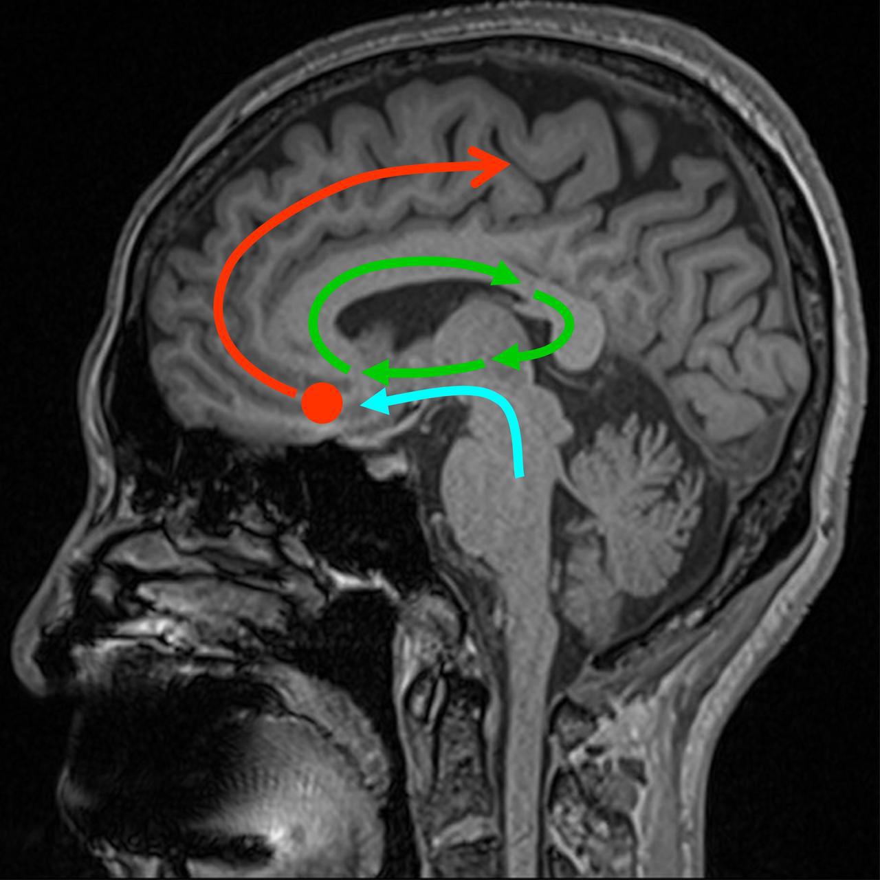 腦鳴在腦部形成的機轉路徑。青色線為腦幹聽覺神經路徑，綠色線為海馬迴中的成癮迴路，紅色線為腦鳴形成後，向其他部位擴散的路徑。圖／陳建志提供