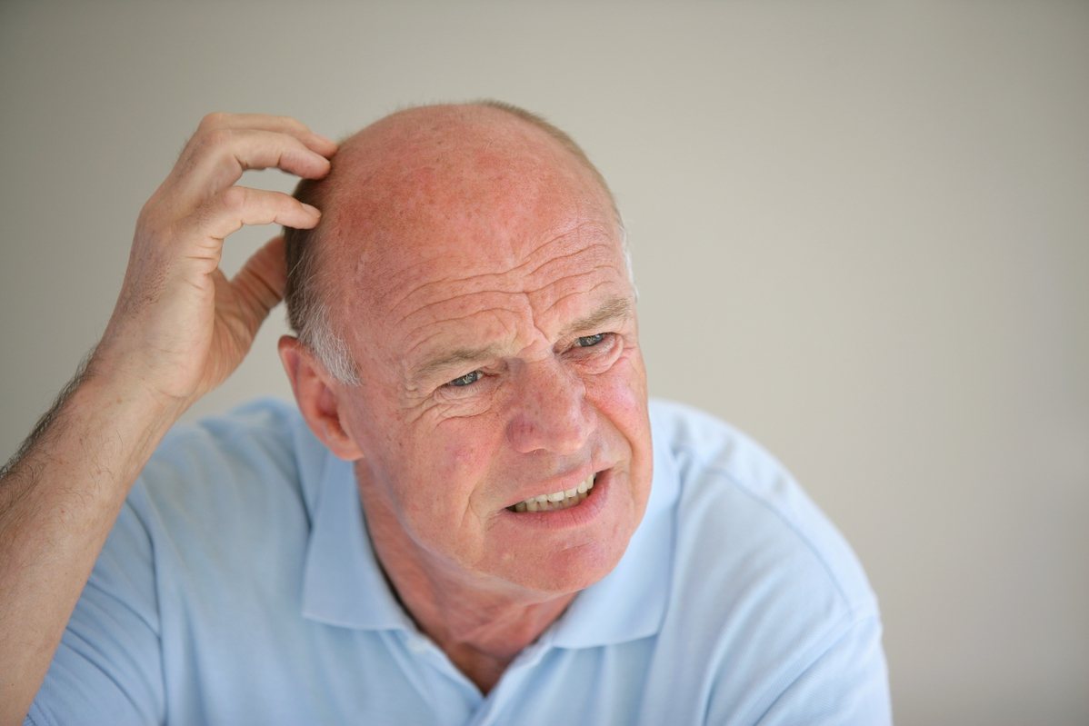 最新調查指出，具有男性型態性禿髮(male pattern baldness)的人感染新冠肺炎嚴重症狀的機率較高。示意圖／Ingimage
