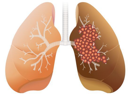 肺腺癌治療就像治療慢性病一樣，醫師可在一開始「超前部署」。圖/123RF