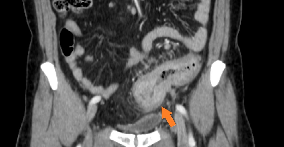 患者腹部電腦斷層影像，箭頭所指為乙狀結腸癌之T3病灶 (腫瘤侵犯穿透肌肉層至漿膜層)。圖／台大醫院新竹分院提供
