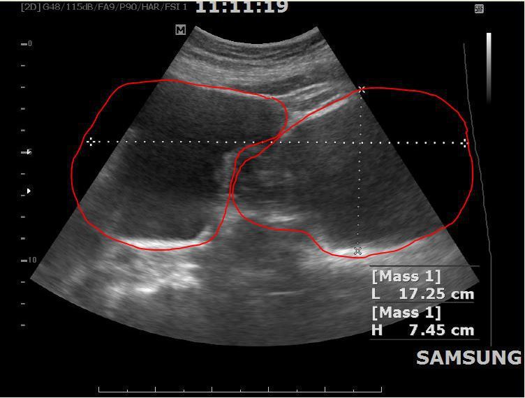 南投85歲阿嬤肚子圓滾滾，經超音波檢查卵巢內有兩顆大水瘤（紅框處）。圖／南投醫院提供